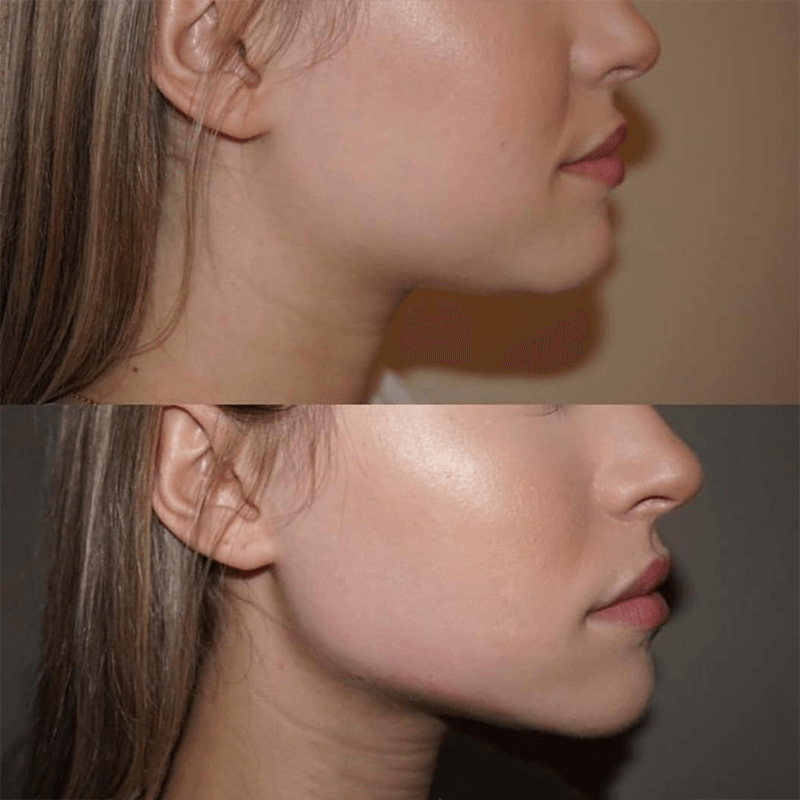 jawline-fillers-in-dubai