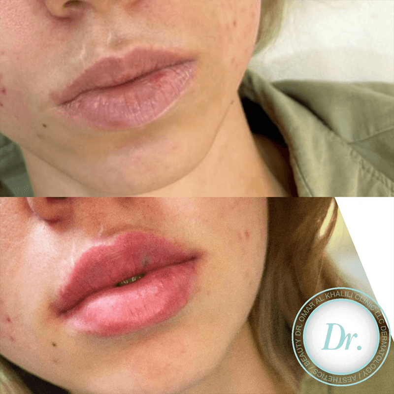 lip-fillers-in-dubai-treatment-uae