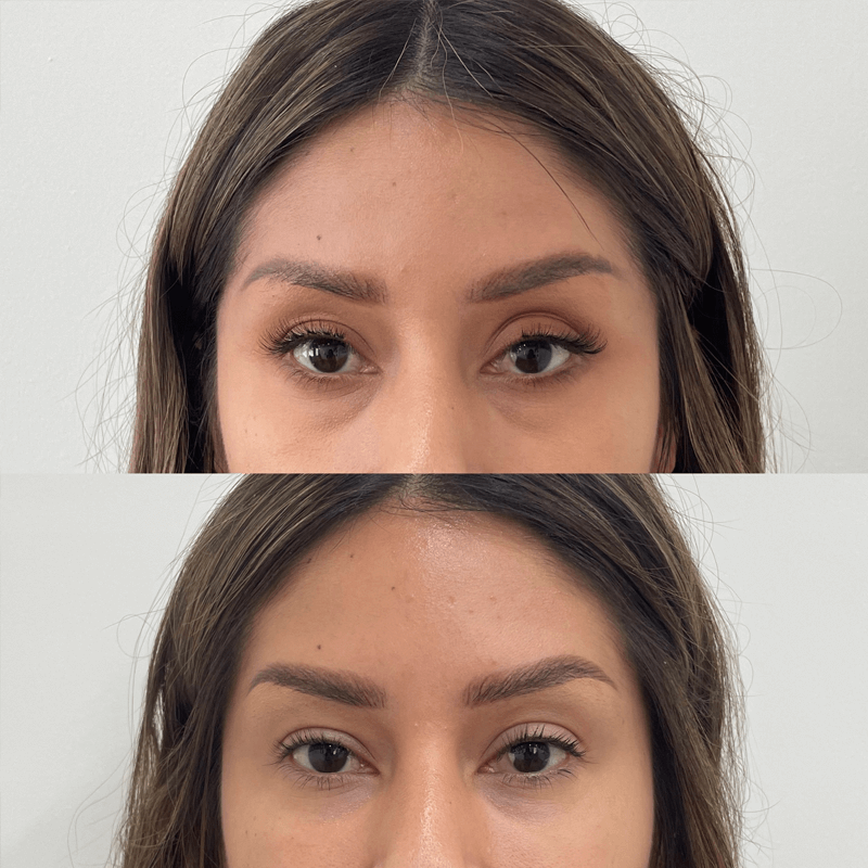 under-eye-fillers-in-dubai